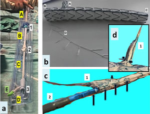 a) Sistema de liberación de prótesis Castor™. Porciones: A: introductor externo, B: mango controlador de camisa interna, C: mango controlador de cánula interna, D: cánula interna, E: control del trigger wire. Seguros de control entre las porciones (para solidarizar o independizar movimientos de las porciones): 1, 2 y 3. b) Componentes de la endoprótesis Castor™. A: rama integrada arteria subclavia izquierda, B: porción proximal aórtica, C: porción distal aórtica, D: hilo con bucles para crimpaje de cada stent, liberación de cada stent controlada por la trigger wire no representada. c) Porción proximal de endoprótesis y sistema liberación tras retirada de camisa interna. 1: capuchón de rama arteria subclavia izquierda (ASI), 2: nariz del sistema liberación. Flechas largas (trigger wire), flecha corta (sujeción de capuchón rama ASI en trigger wire). d) Rama ASI. 1: capuchón de rama ASI. Flechas cortas (sujeción de capuchón rama ASI en trigger wire tras retirada de la misma).