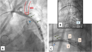 Implante paso a paso (I): A) Guías entrelazadas (2 vueltas) con flechas largas. Radiomarcador de 8 de camisa interna normoposicionado en curvatura menor con flechas cortas. B) Guías no entrelazadas, normoposición radiomarcadores de base de rama. C) Detalle ampliado de imagen B. Guías no entrelazadas con flechas largas. Radiomarcador de 8 de camisa interna normoposicionado en curvatura menor con flechas cortas. 1: radiomarcadores proximales aórticos, 2: radiomarcadores distales de rama de ASI, 3: radiomarcadores basales de rama de ASI. ASI: arteria subclavia izquierda; IE: introductor externo.