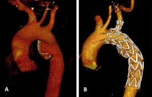 Caso clínico 1. A) Tomografía axial computarizada preoperatoria, B) Tomografía axial computarizada postoperatoria.