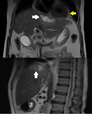 Subphrenic collection (white arrows). Pericardial sac with no evidence of involvement (yellow arrow).