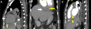 (A) Simple CT of the chest showing residual pericardial effusion (white arrows) and pericardiocentesis catheter in the pericardial cavity (yellow arrows). (B) Subphrenic collection measuring 8cm×3cm×2cm with an estimated volume of 25cc (white arrow). Catheter in the pericardial cavity (yellow arrow). (C) Thinning of the diaphragm at the level of the collection and pericardial sac with apparent fistulous tract.