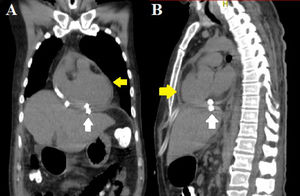 Control CT scan after subxiphoid pericardial window. (A) Pericardial sac with minimal pericardial effusion (yellow arrow). (B) Pericardial and subphrenic drains (white arrows).