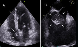 A)Ecocardiografía transtorácica proyección apical 4cámaras. B)Ecocardiografía transesofágica eje de cavas. Masa auricular derecha anclada al septo interauricular con densidad heterogénea y zonas ecorrefringentes sugestivas de calcificación (flechas).