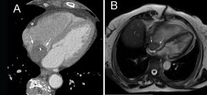 A)Tomografía computarizada. B)Resonancia magnética nuclear. Se aprecia masa auricular derecha, redondeada, que no capta contraste, se asienta sobre el septo interauricular y presenta calcificaciones (flechas).