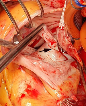 Imagen intraoperatoria desde la cabecera. Auriculotomía derecha. El quiste se ha vaciado de sangre de modo espontáneo. La pinza sostiene la pared del quiste. Se aprecia su fijación (flecha) al septo interauricular cercana al borde inferior de la fosa oval.