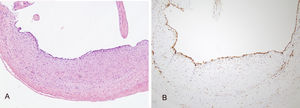 Estudio histopatológico. A)Hematoxilina eosina ×100. Se aprecia pared del quiste de carácter fibroso, internamente tapizada de células aplanadas. B)Inmunotinción positiva con anticuerpos frente CD31 ×100. El endotelio se tiñe intensamente de color ocre.
