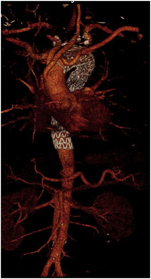 Tratamiento endovascular del arco aórtico (TEVAR).