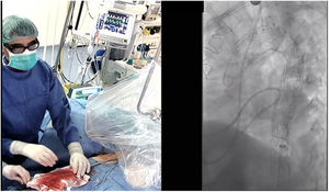 Segundo tiempo de cirugía híbrida. TEVAR en paciente con cirugía de derivación aortocoronaria previa.
