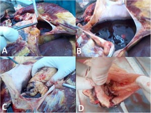 Cardiac tamponade with clotted blood in pericardial cavity (A, B), rupture of aorta at origin (C) and dissection of aortic wall (D).
