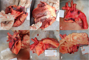 Rupture of aorta near coronary artery opening (A, B), splitting of wall into two layers of ascending, arch and descending aorta (C–E) and atheromatous plaque at various sites (F).