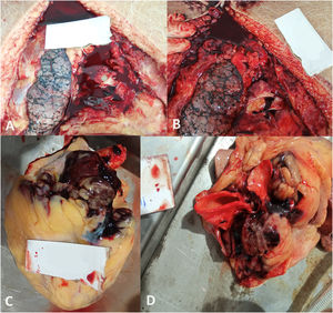A and B shows opening of pericardium with large collection of clotted blood in pericardial cavity, rupture of aorta at origin of ascending part (C), and double lumen aorta (D).