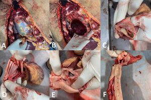Cardiac tamponade with unopened pericardium showing collection of blood (A), after opening it showing large clotted blood in cavity (B), double lumen aorta (C, D, F) rupture at origin of ascending aorta (E).