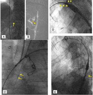 Implante dispositivo CratosTM (I): A) Potenciales maniobras coadyuvantes para procedimiento: marcaje de tronco celíaco con Guía Rosen (Cook) 0,035” (flecha). B) Potenciales maniobras coadyuvantes para procedimiento: angiografía con CO2 para identificación de tronco celíaco (flecha). C) Montaje de T&T braquio-femoral en aorta ascendente con lazo Indy® (COOK Incorporated, Bloomington, IN, EE. UU.). D) Guía de tracción ASI entrelazada (flechas), alrededor de nariz del sistema liberación. E) Extracción del sistema liberación a zona recta en ATD para recolocación, radiomarcador «8» de la camisa interna girando (flecha). ASI: arteria subclavia izquierda; ATD: aorta torácica descendente; T&T: through-and- through; VCI: vena cava inferior.
