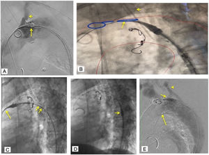 Implante dispositivo Cratos™ (II): A) CratosTM normoposicionada para iniciar el pull-back del introductor externo (flecha larga), que se realiza en proximidad de ASI (flecha corta), a diferencia de CastorTM. B) CratosTM normoposicionada para iniciar el pull-back del introductor externo (flecha larga), que se realiza en proximidad de ASI (flecha corta), con apoyo de Fusión marcando ostium ASI (flecha larga). C) Retirada de parte floppy de guía Lunderquist® 300mm (COOK, Bloomington, IN, EE. UU.) hacia la nariz (flecha larga) favorece el posicionamiento del catéter liberador en curvatura menor (flechas cortas), permitiendo activar el control del pico de pájaro. D) Con la activación del dial número 4, se retira la nariz / catéter liberador hacia el introductor externo. E) Angiografía control con posicionamiento óptimo de radiomarcadores (en este caso, plataforma de liberación CastorTM): «8» curvatura menor (flecha larga), círculos base de la rama ASI (flecha mediana), círculos extremo distal cubierto de rama ASI (flecha corta). ASI: arteria subclavia izquierda.