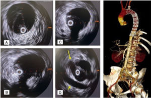 IVUS verificando normoposición de guía en VL previo a implante endoprótesis en disección aorta tipo B subaguda (caso 3): A) IVUS a nivel aorta torácica distal. B) IVUS a nivel de tronco celíaco. VL casi colapsada. C) IVUS a nivel de arteria mesentérica superior. D) IVUS a nivel de arterias renales, ambas saliendo de VL. Arteria renal derecha (flecha larga), vena renal izquierda (flecha corta). E) Tomografía axial computarizada en el postoperatorio inmediato: reconstrucción 3D (volume rendering). Origen de troncos viscerales desde VL y adecuada expansión VL. Arco bovino. IVUS: intravascular ultrasound; VL: verdadera luz.