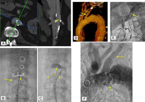 Procedimientos endovasculares adicionales: Caso 4: Disección tipo B crónica, estadío torácico previo a F/BEVAR. A) Tomografía axial computarizada preoperatoria. Fenestración (flecha) calcificada en septo correspondiente a ostium original de arteria renal derecha. B) Fusión para marcaje de ostia viscerales y fenestración de septo. Uso IVUS (flecha corta) para comprobar guía en FL (flecha larga). C) Angioplastia con balón 12×20mm (flecha larga) sobre guía Rosen 0,035” cruzando de VL a FL (flechas cortas) a nivel de fenestración de septo para optimización de la misma. Caso 5: D) Origen anómalo (flecha) de vaso mediastínico a 1cm de ostium ASI. E) Extensión distal de rama ASI con Gore® Viabahn® VBX stent balón-expandible 11/39mm (flecha). F) Embolización con coils de rama mediastínica (flecha corta), extensión de rama ASI con stent cubierto (flecha larga). ASI: arteria subclavia izquierda; FL: falsa luz; F/BEVAR: fenestrated/branched endovascular repair; IVUS: intravascular ultrasound; VL: verdadera luz.