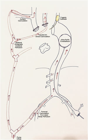 Cannulation strategy scheme to perform normothermic arch replacement. In this case, bilateral antegrade cerebral perfusion is provided and the lower body perfusion is achieved by femoral cannulation and placement of an endoballon occluding the descending thoracic aorta.