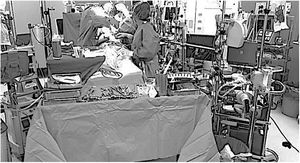 Complejidad de un quirófano de cirugía cardiovascular. Vemos: recuperador hemático, extracorporeal membrane oxygenation (ECMO), balón intraaórtico de contrapulsación, ecocardiógrafo transesofágico, analizador de coagulación, bomba centrífuga y de circulación extracorpórea.