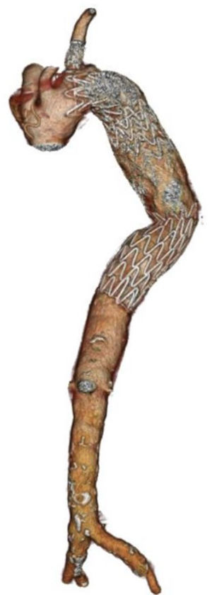 VR en TC de control tras implante de endoprótesis TBE™ y extensión con CTAG™. CTAG: Conformable Thoracic Aortic Graft; TBE: Thoracic Branch Endoprosthesis; TC: tomografía computarizada; VR: volume rendering.