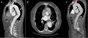 A y B)Corte sagital y axial, respectivamente, que muestran aneurisma de aorta torácica y hematoma en su pared (flechas blancas). C)Corte sagital en TC de control tras implante de endoprótesis con rama para ASI (flecha roja). ASI: arteria subclavia izquierda; TC: tomografía computarizada.