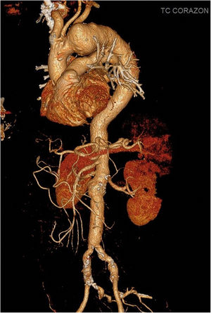 Angio-tomografía axial computarizada preoperatoria del caso 1. Aneurisma de arco aórtico de 61×48mm.