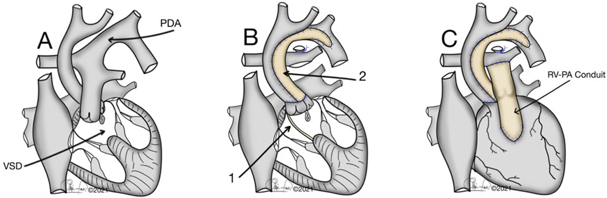 Subaortic Ridge Types One-stage neonatal Yasui procedure: Presentation of our surgical ...