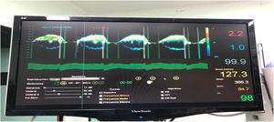 Monitor empleado con espectrograma y valores medidos (flujo adecuado del injerto mostrado).