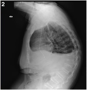 Derecha) Rx de tórax: proyección lateral: presencia de electrodo monocameral endocavitario extremo distal intraventricular.