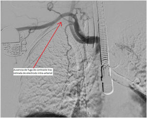 Ausencia de fuga de contraste, tras retirada del electrodo intraarterial (transaórtico) y escopia intraquirófano.