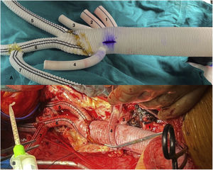 Imagen comparativa injerto dacron home-made tras su confección y tras su implante (caso 1). A) Anastomosis biselada término-terminal de injerto multirrama 30mm (Gelweave™ Coselli Thoracoabdominal Graft, Terumo Aortic, Inchinnan, Escocia) y cuerpo bifurcado 20×10×10mm (AlboGraft®, LeMaitre Vascular, Burlington, EE. UU.), así como porción de injerto dacron knitted 10mm a rama izquierda del bifurcado mediante anastomosis término-lateral y en posición ascendente, permitiendo así la canulación del sistema arterial con conexión 3/8-3/8-3/8. Anastomosis con monofilamento 4/0 y biosellante NE’X Glue® (Grena Biomed Ltd., Nottingham, Reino Unido). Marcaje con rotulador de posición superior del injerto. B) Prótesis implantada en paciente. 1. Rama a tronco celíaco. 2. Rama a arteria mesentérica superior. 3. Rama a arteria renal derecha. 4. Rama a arteria renal izquierda. 5. Rama a arteria ilíaca común derecha. 6. Rama a bifurcación arteria ilíaca izquierda. 7. Rama de perfusión sistémica y de conexión a injerto de reimplante de intercostales (técnica snake).