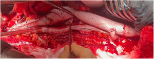 Visión general tras finalizar la sustitución de la aorta toracoabdominal (caso 1). 1. Prótesis de aorta a nivel supradiafragmático. 2. Rama a arteria renal izquierda. 3. Rama a arteria ilíaca común derecha. 4. Rama a bifurcación arteria ilíaca izquierda. 5. Injerto para reimplante de arterias intercostales (técnica snake). 6. Anastomosis proximal del injerto snake. 7. Anastomosis distal del injerto snake. 8. Anastomosis proximal con injerto previo de aorta torácica descendente.