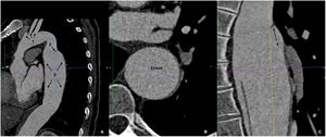 Tomografía axial computarizada preoperatoria con reconstrucción multiplanar del caso 2. Disección de aorta tipo B que se inicia en aorta descendente proximal y se extiende distalmente. A. Corte sagital: cayado y origen de troncos supraaórticos (1), puerta de entrada (2), dilatación difusa de aorta torácica descendente (3). B. Corte axial. Dilatación aneurismática de aorta torácica descendente, diámetro máximo 51mm en zona 4. C. Corte coronal: amplia puerta de entrada (rotura intimal) en zona 4 (4).
