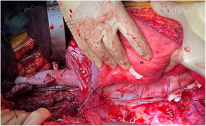 Visión general tras finalizar la sustitución de la aorta toracoabdominal (caso 2). 1. Pericardio bovino cubriendo injerto aórtico en tórax. 2. Costotomía posterior de sexta costilla izquierda. 3. Frenotomía parcial circunferencial. 4. Rama a arteria mesentérica superior. 5. Rama a arteria renal izquierda. 6. Anastomosis distal de snake. 7. Rama a bifurcación arteria ilíaca izquierda. 8. Injerto snake con áreas de reimplante de arterias segmentarias en zona infradiafragmática. 9. Muñón (ligado) de injerto de perfusión conectado a rama ilíaca izquierda. PI: pulmón izquierdo.