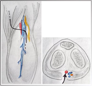 Se muestra la incisión en S itálica para el abordaje posterior de la poplítea. Visualización del recorrido de la vena safena externa. Se muestra la disposición anatómica del paquete vasculonervioso (rojo: arteria poplítea; azul: vena poplítea; amarillo: nervio).