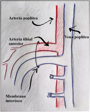 Abordaje proximal de los troncos distales. Se visualizan los primeros centímetros de la arteria tibial anterior atravesando la membrana interósea y la vena tibial cruzando por encima de la arteria