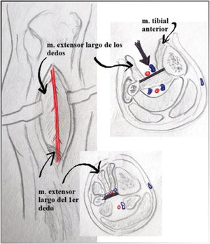 Abordaje lateral de la arteria tibial anterior proximal y distal con la disposición de los músculos a ese nivel.