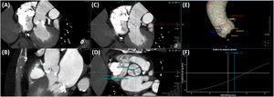 (A) y (B): medición de la altura desde el anillo hasta los ostia coronarios mediante TC; (A): tronco de la coronaria izquierda; (B): arteria coronaria derecha. (C) y (D): medida de los senos de Valsalva, de seno a comisura. (E) y (F): predicción de la proyección coplanar óptima mediante TC.