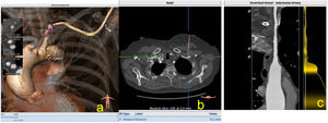 a) Imagen de reconstrucción en modo VR de las medidas, de las tortuosidades y el sitio de punción axilar; b) Corte axial que muestra la profundidad en el sitio de punción; c) Imagen en modo MPR, donde podemos evaluar la arteria axilar en toda su longitud hasta la aorta ascendente.