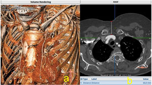 a) Evaluación del tronco braquiocefálico derecho, en modo VR; b) Corte axial donde se muestra la profundidad de dicha arteria, algo que puede ser importante de cara a la planificación quirúrgica.