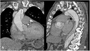 Angio-tomografía preoperatoria del caso 2. A) Plano coronal. Disección de raíz y aorta ascendente. B) Plano sagital. Disección de arco distal y aorta torácica descendente.