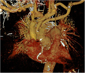 AngioTC postoperatoria del caso 2. Estrella: injerto axilar izquierdo con curso intratorácico. Flecha: injerto coronario de safena a coronaria derecha.