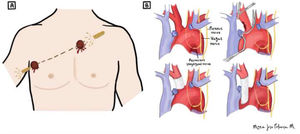 Diagram illustrating (A) The gunshot trajectory of the patient; the bullet entered the right hemithorax at the 5th intercostal space along the anterior axillary line and exited the left hemithorax at the 3rd intercostal space along the left parasternal line. (B) The surgical reconstruction of the brachiocephalic trunk performed during surgery.