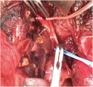 Gunshot wound of the bifurcation of the brachiocephalic trunk with compromise of the 60% of the vessel with injury of the right common carotid artery and the right subclavian artery (arrow). AoA: aortic arch, BCT: brachiocephalic trunk, RCCA: right common carotid artery, RSCA: right subclavian artery.