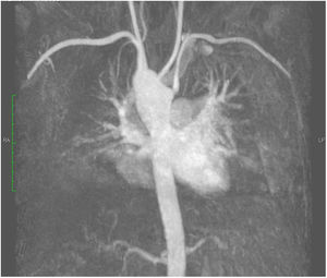 Angiorresonancia de tórax, corte coronal; se observa arco aórtico derecho con arteria subclavia izquierda aberrante con nacimiento en divertículo de Kommerell.