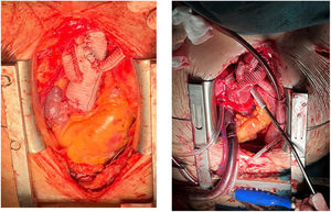 Reparación híbrida de arco aórtico tipo II. Abordaje quirúrgico mediante esternotomía media y con circulación extracorpórea.