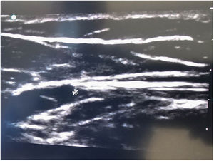 Aspecto ecográfico del catéter blanco en visión longitudinal, cerca de la USF. Punta del mismo marcada con un asterisco blanco.