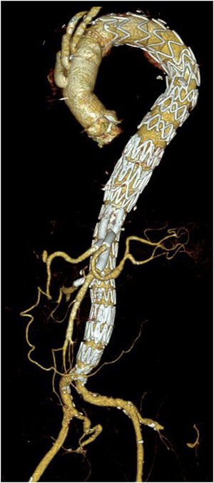 Angio-CT control of endovascular repair, with a customised endograft with 4 visceral branches, of an extent I thoraco-abdominal aneurysm in a 76-year-old woman with a previous surgical history of open aortic arch replacement with a classic elephant trunk.