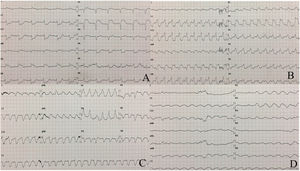 Las figuras 1A-D muestran la evolución electrocardiográfica de la paciente, con un ensanchamiento progresivo del QRS hasta su completa desaparición.