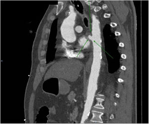 Tomografía computarizada (TC). Las flechas señalan la fístula aortoesofágica.