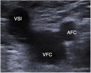 Imagen de Mickey Mouse. AFC: arteria femoral común; VFC: vena femoral común; VSI: vena safena interna.